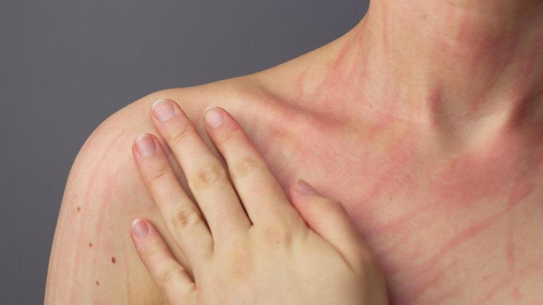 Гугл и Яндекс-картинки. Экскориационное расстройство. Раздирание кожи. Листайте галерею вправо. 