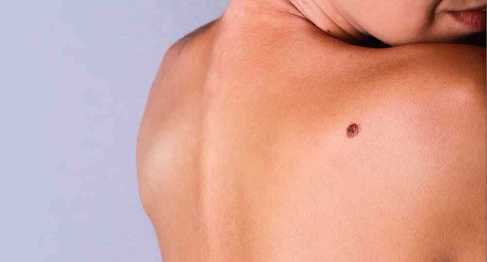 Как понять, что родинка перестала быть безобидной