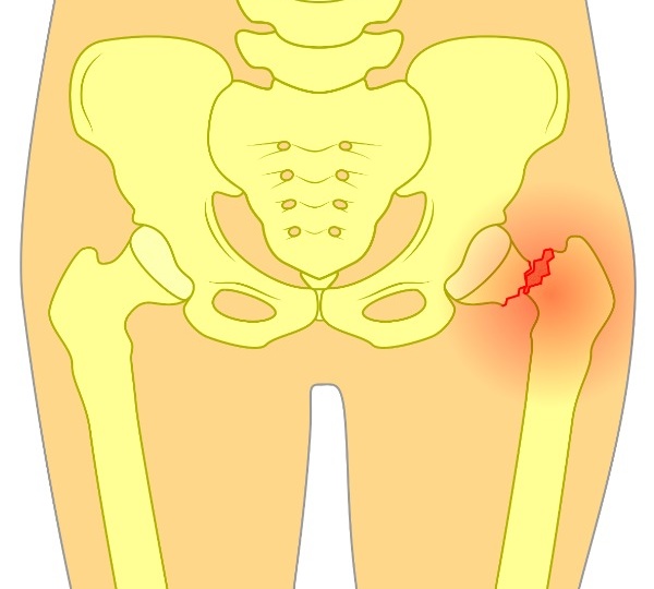 Перелом шейки бедра: тяжелая травма «на ровном месте»