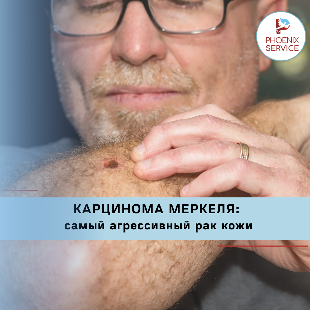 Редкая, но крайне агрессивная опухоль кожи, которую часто принимают за безобидный узел.