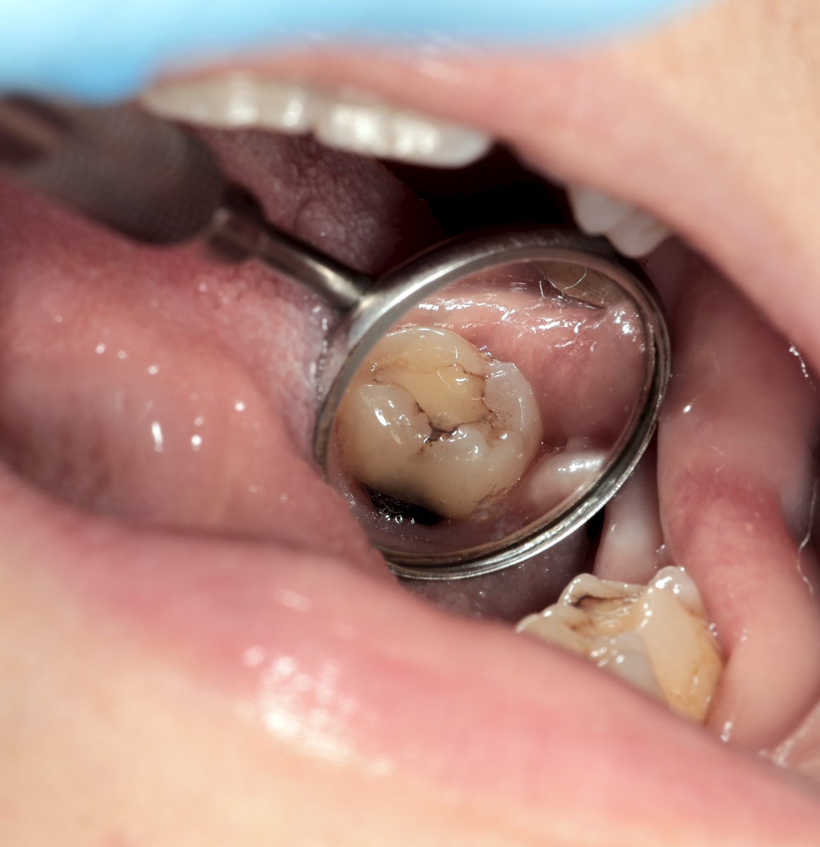 Кариес корня 3.7 зуба с язычной стороны