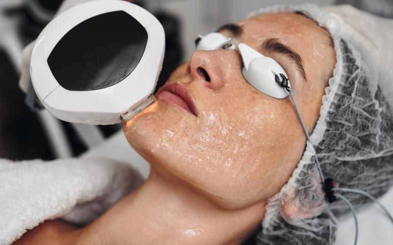 IPL даёт естественный и “честный” эффект — кожа становится ровнее и спокойнее без ощущения вмешательства, а результат усиливается постепенно по мере курса.