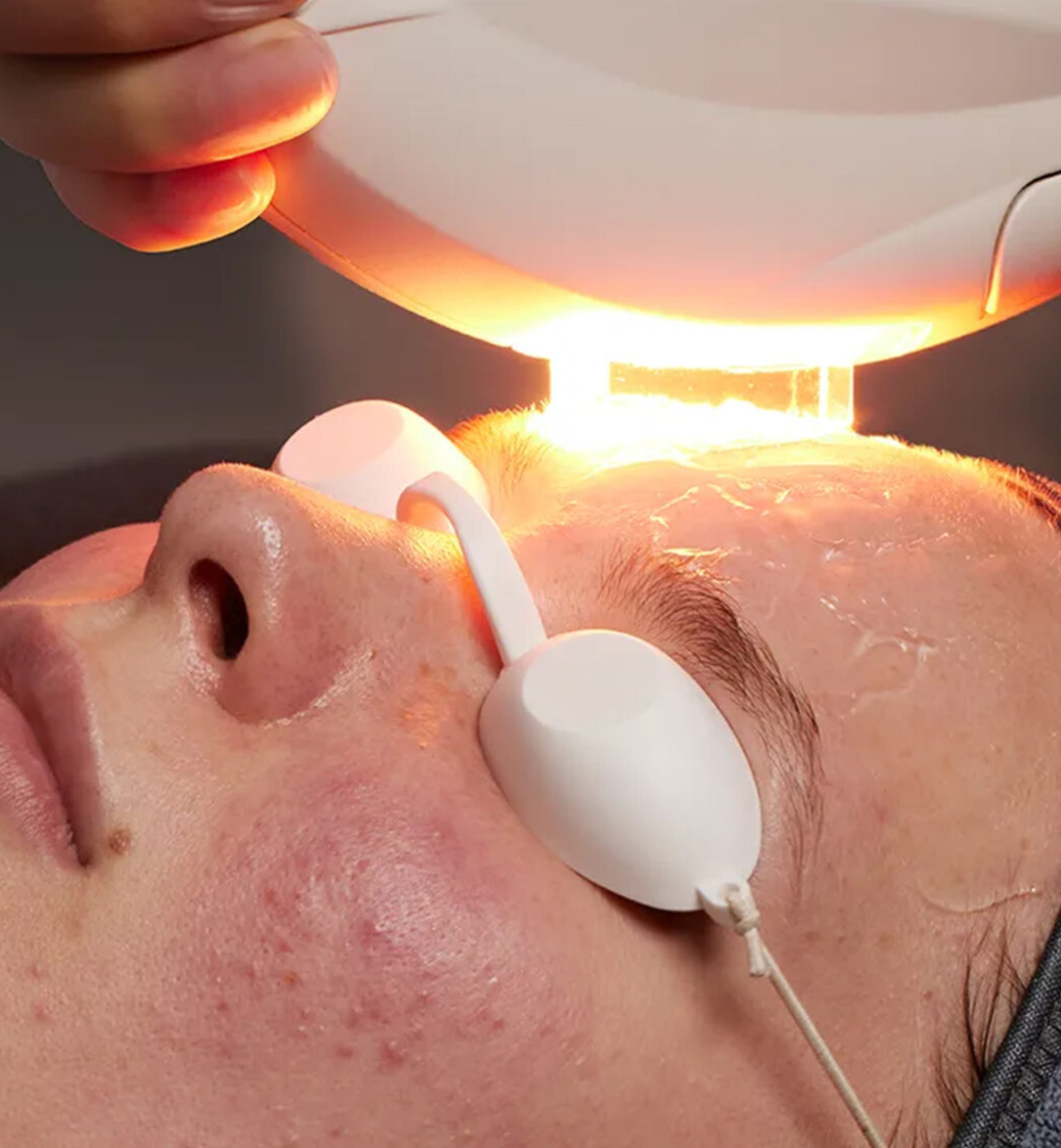 IPL — это процедура для выравнивания тона кожи: уменьшает покраснения, сосудистую сетку и пигментные пятна, делая лицо визуально более чистым и спокойным.