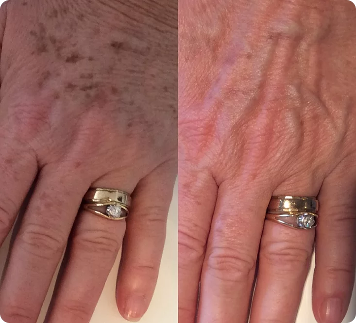 Результат кожи рук ДО и ПОСЛЕ процедуры Lumecca