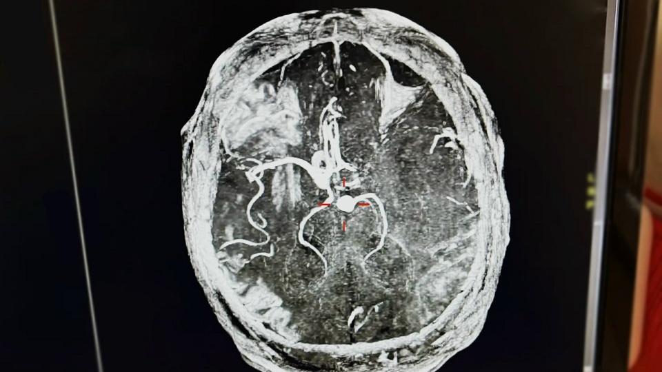 Пил по 8 банок энергетика: врачи чудом спасли 43-летнего рязанца с инсультом