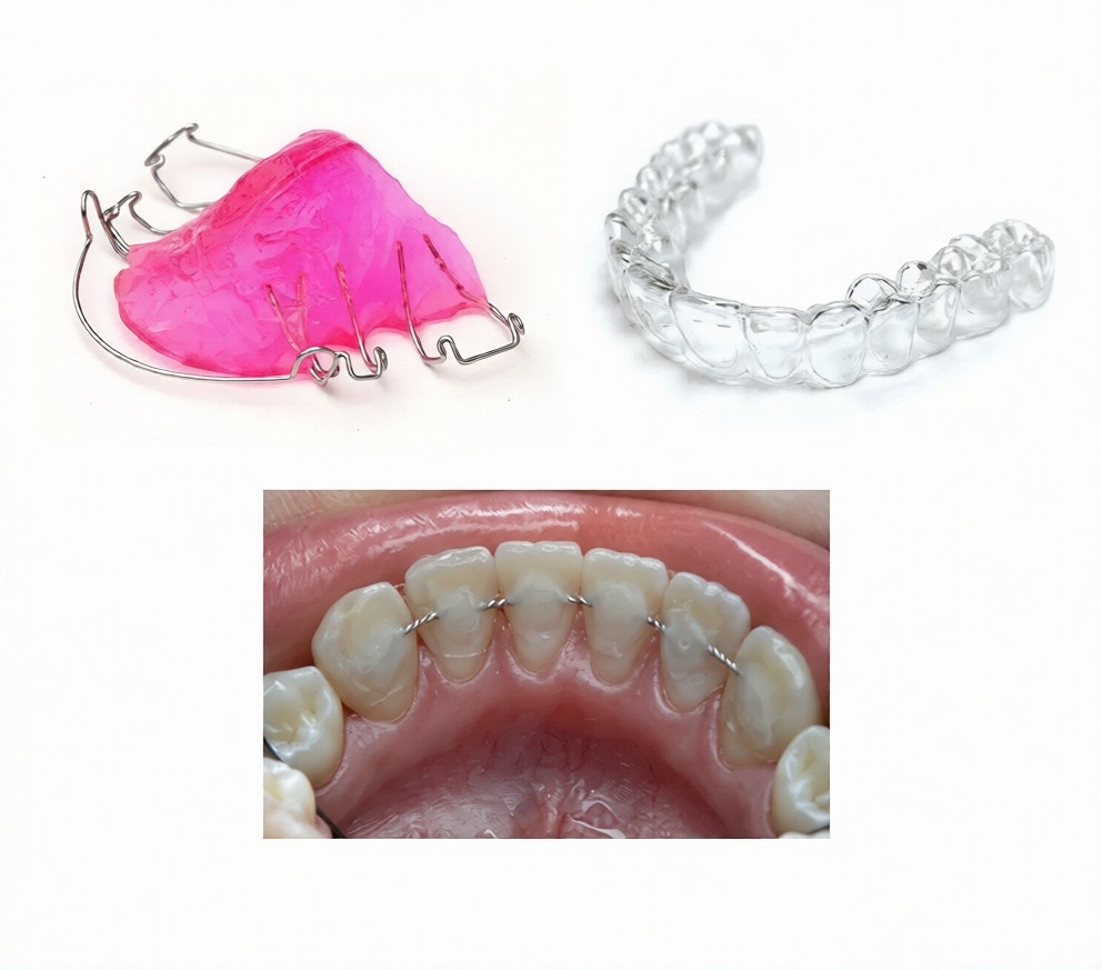 Виды ретейнеров