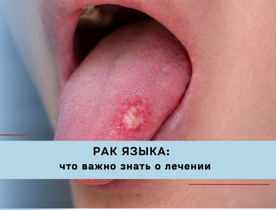 Рак языка может долго протекать без симптомов. Рассказываем, на что обратить внимание и какие методы лечения применяются сегодня.