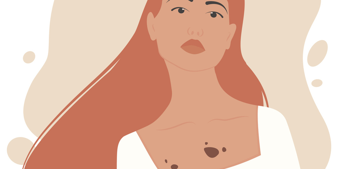 Родинки: как проверять кожу?