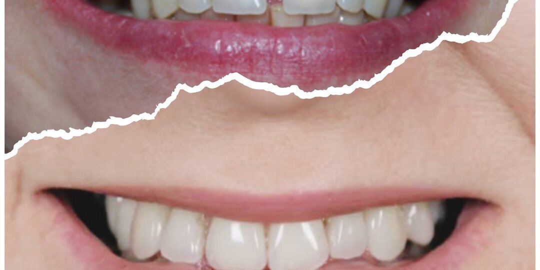 Зубы начали "ползти" в 58, хотя всегда были ровные. Рассказываю, как я спасла свою улыбку без брекетов