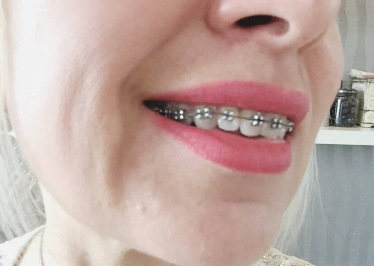 Брекит точно не мой вариант 