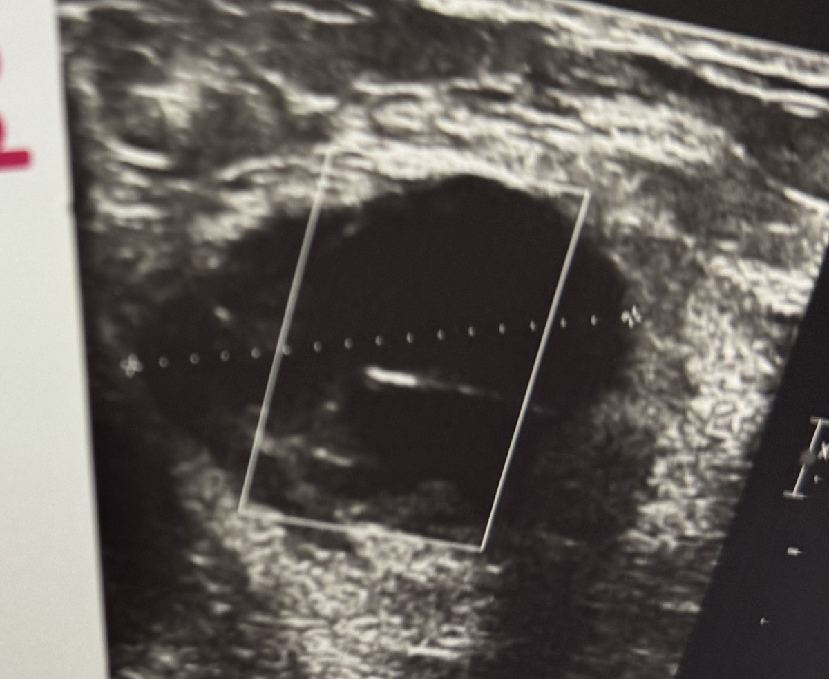 Вот так выглядело новообразование по УЗИ - практически типичная обыкновенная киста, но с утолщенными стенками и небольшим пристеночным компонентом.