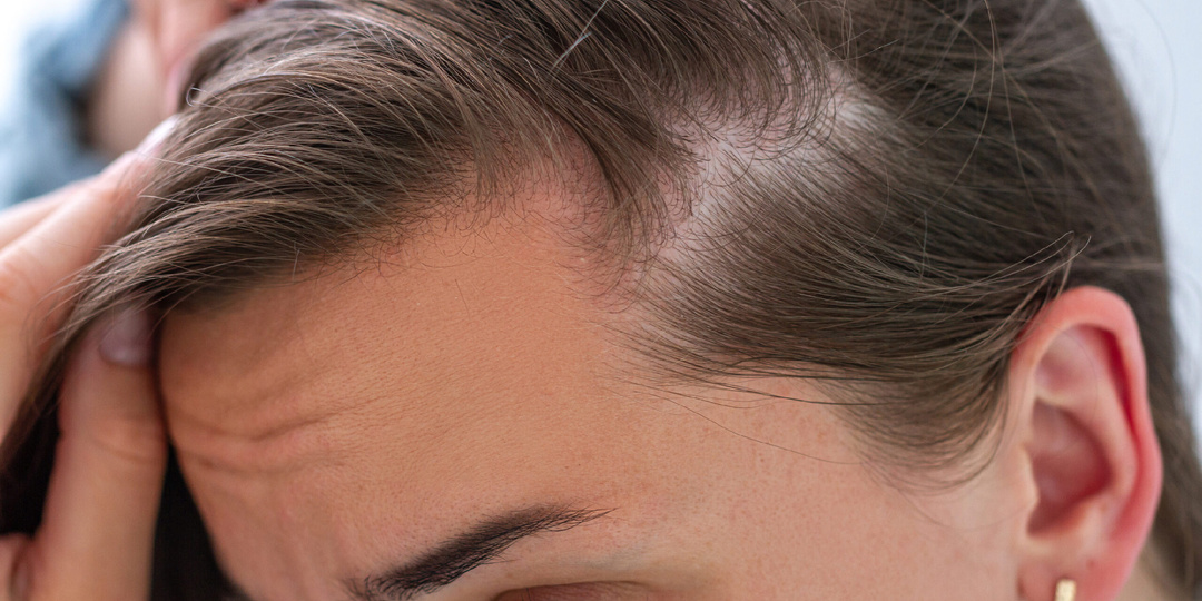 Редеют волосы? Что делать, чтобы вернуть густоту