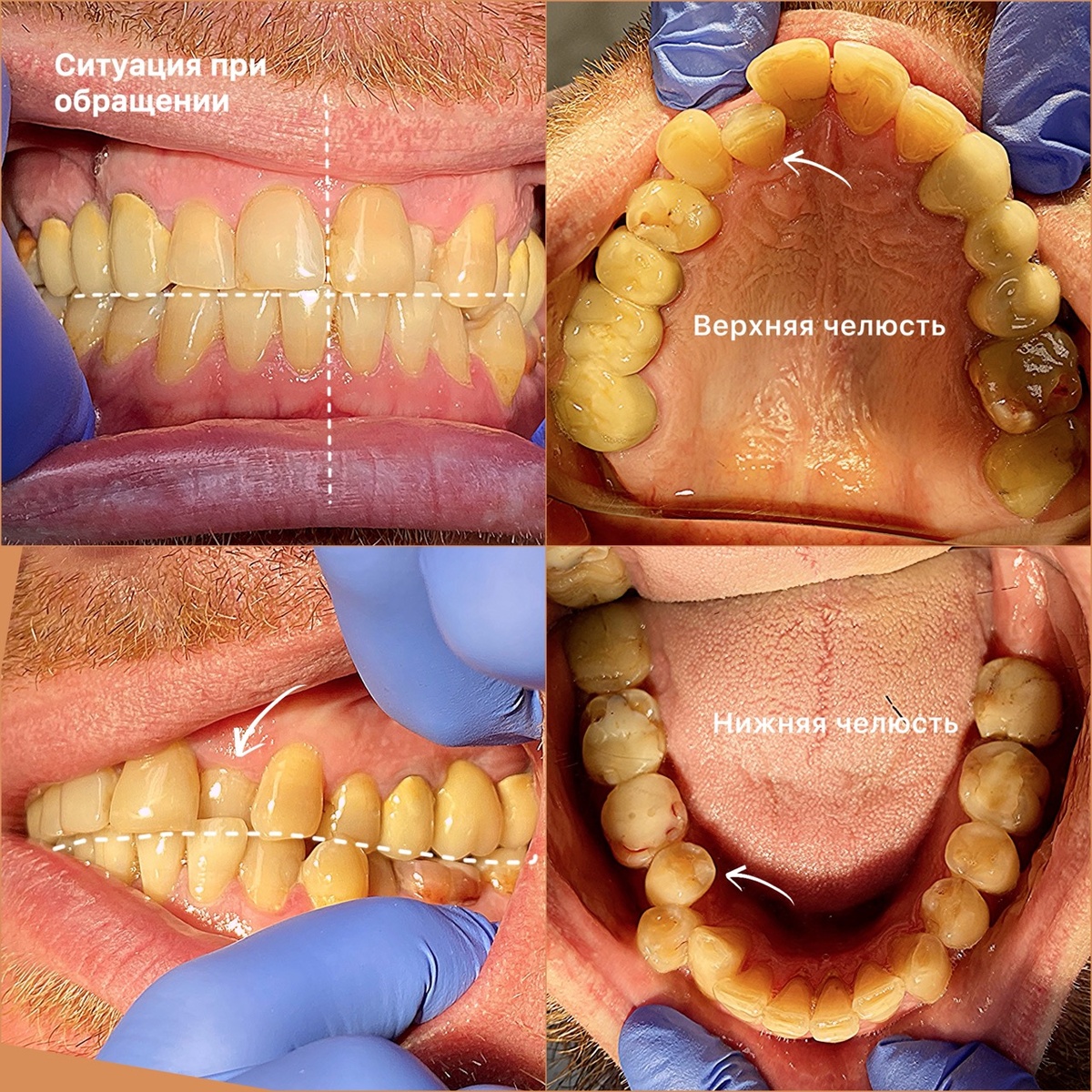 Исходная ситуаци пациента при обращении в нашу клинику