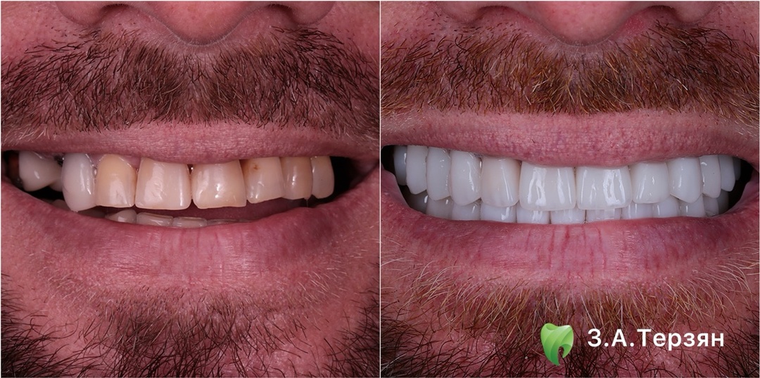 Как устанавливают виниры?