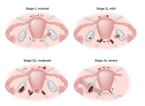 Диагностика и лечение эндометриоза