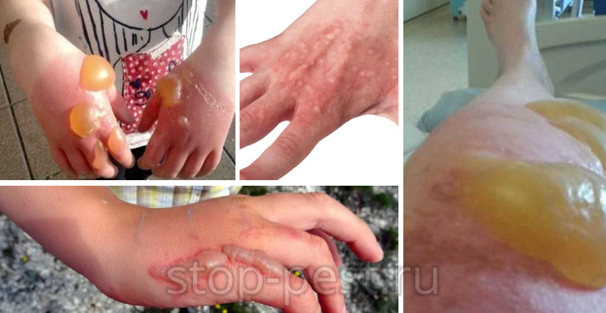 Кожные поражения при контакте с соком борщевика Сосновского, фото сайта https://stop-pest.ru