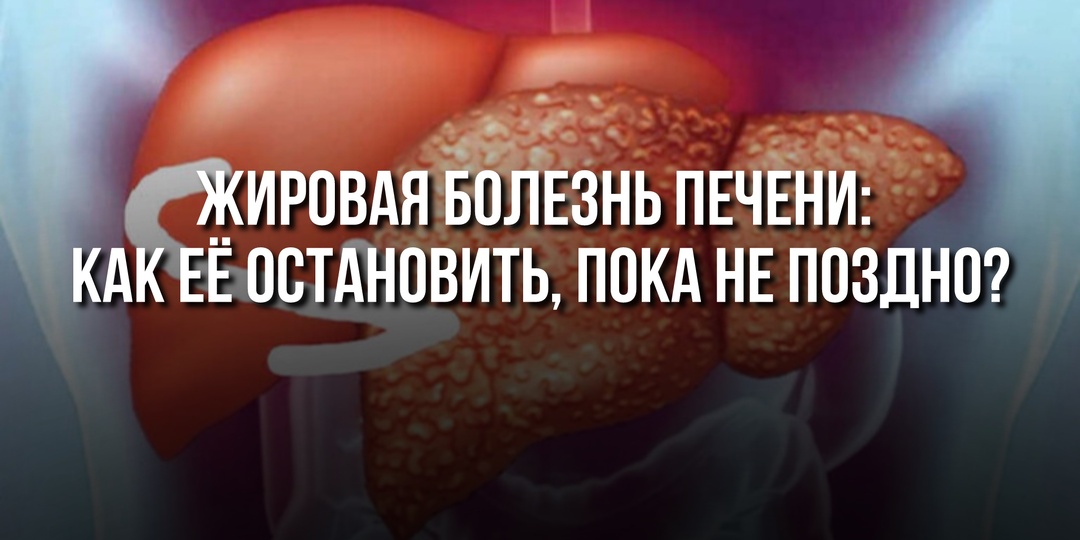 Жировая болезнь печени: как её остановить, пока не поздно?