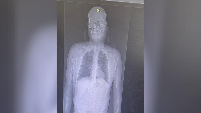 В Саратовской области мужчина попал в больницу после падения с «Эйфелевой башни». Фото © Telegram / ГУЗ СО «Балаковская городская клиническая больница»