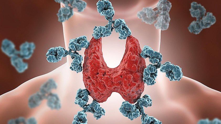 Аутоиммунные заболевания (гипотиреоз Хашимото) — почему появились сейчас