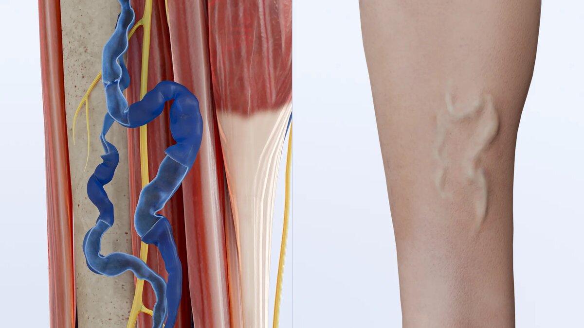Хирург предостерег: боль в ноге может закончиться трагедией. Причины, лечение и опасный вариант течения