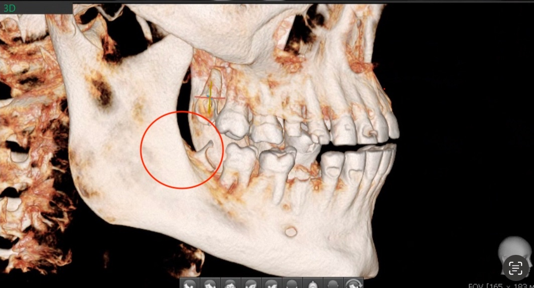 Места нет (скрин - лишь пример, тут 8 зуб вообще разрушен и наклонён в сторону 7)