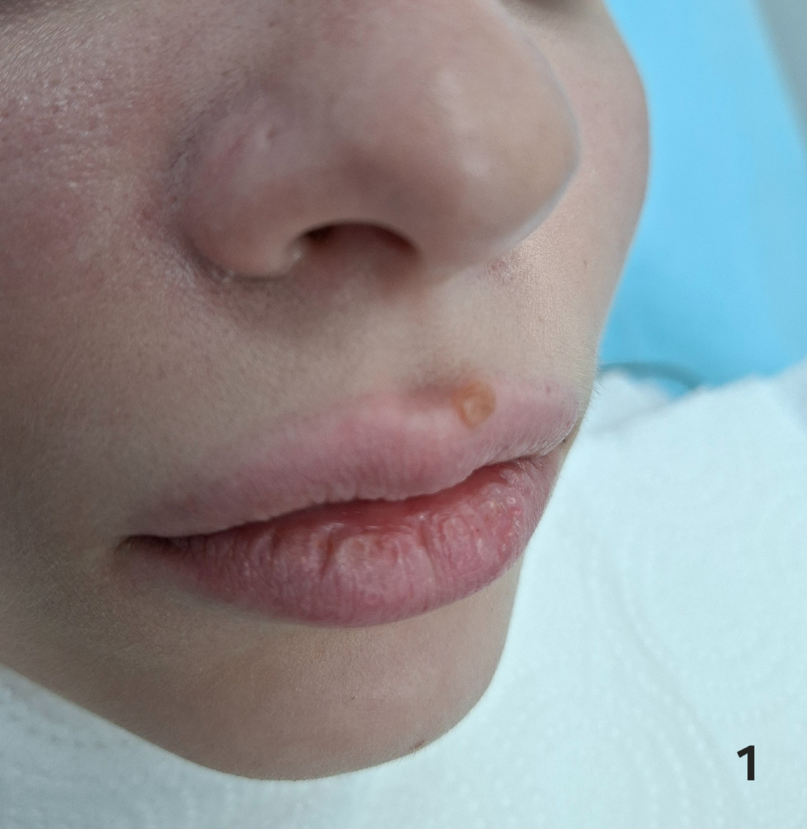 На 1 фото состояние перед операцией. Хорошо видно округлое новообразование верхней губы.