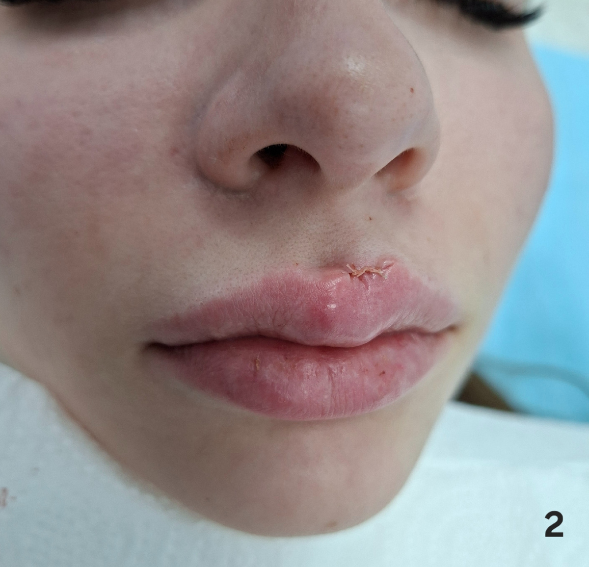 На 2 фото - состояние сразу после операции. Хорошо видны лигатуры (нити) , удерживающие края раны в соприкосновении.