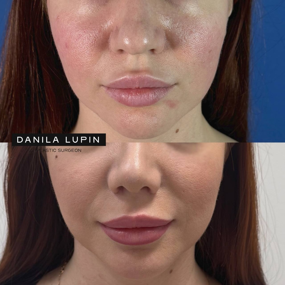 Моя пациентка. Выполнили риносептопластику с латеропозицией носовых раковин.