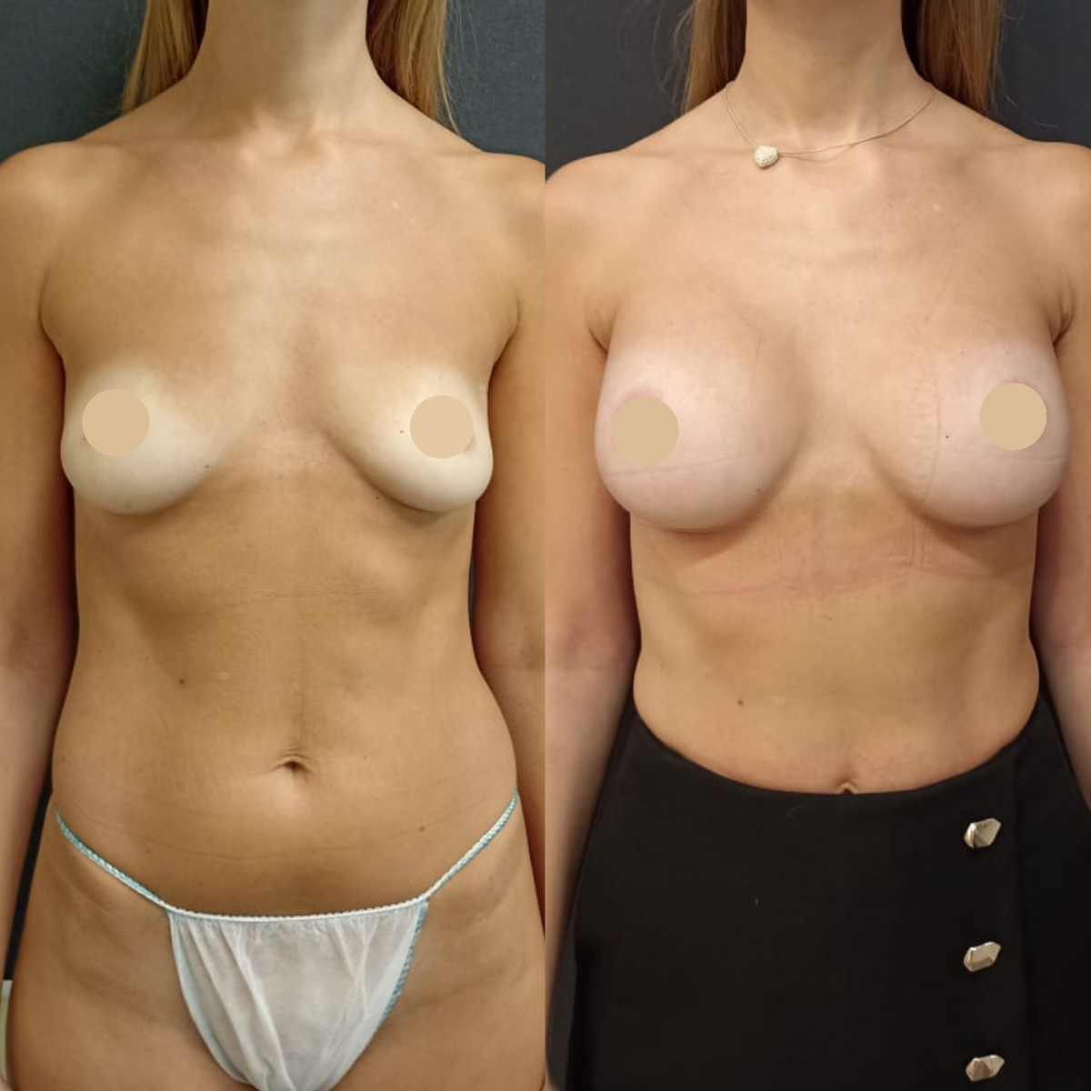 Увеличивающая маммопластика в исполнении Новосёлова Олега Александровича