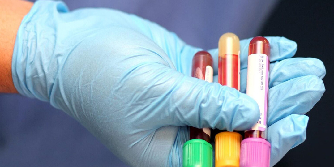Онкомаркеры: когда сдавать анализ, чтобы спасти свою жизнь? Главное — не опоздать