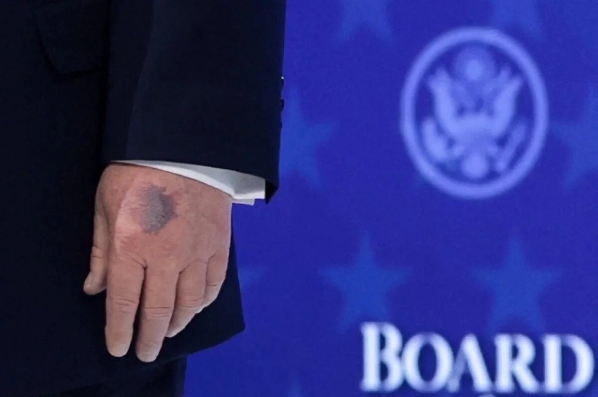    Трамп раскрыл тайну своего синяка, который пресса обнаружила в Давосе