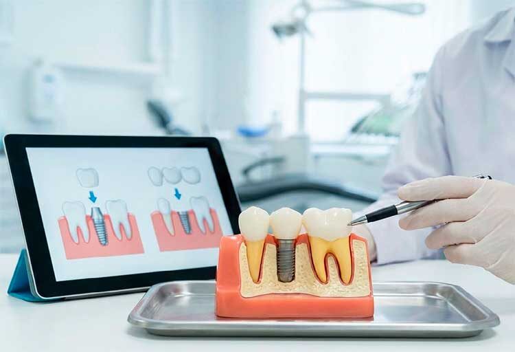 Импланты или мост: что лучше поставить, если потерян зуб