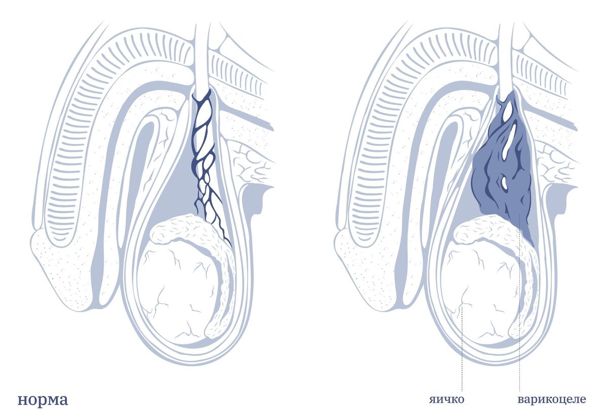 Варикоцеле норма/ отклонение