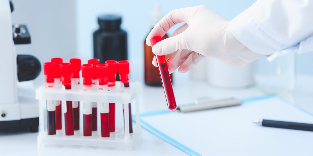 Ученые из Дебреценского университета оценили прогностическую ценность соотношений клеток венозной крови у пациентов с острым ишемическим