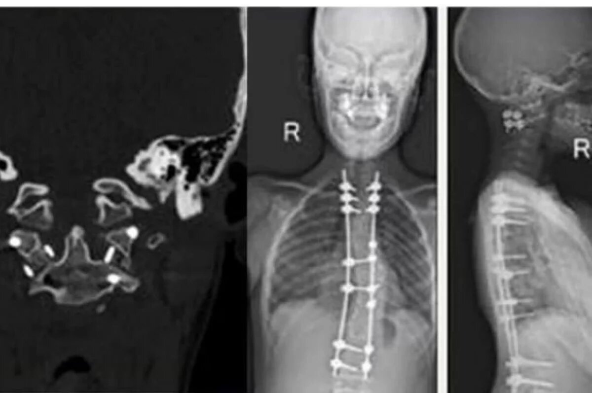    Врачи вернули возможность ходить парализованному подростку из Перми