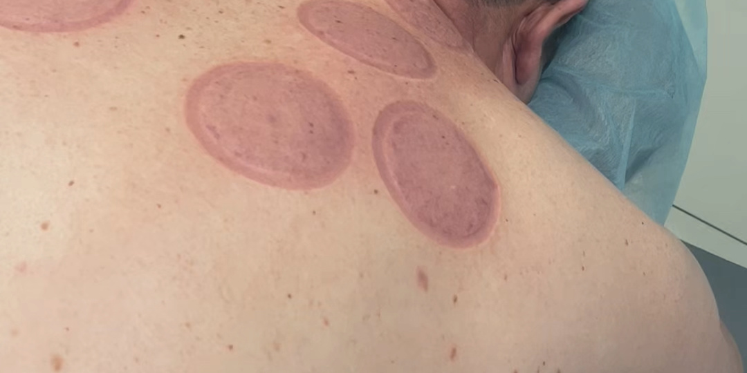 БАНОЧНЫЙ МАССАЖ - CUPPING THERAPY