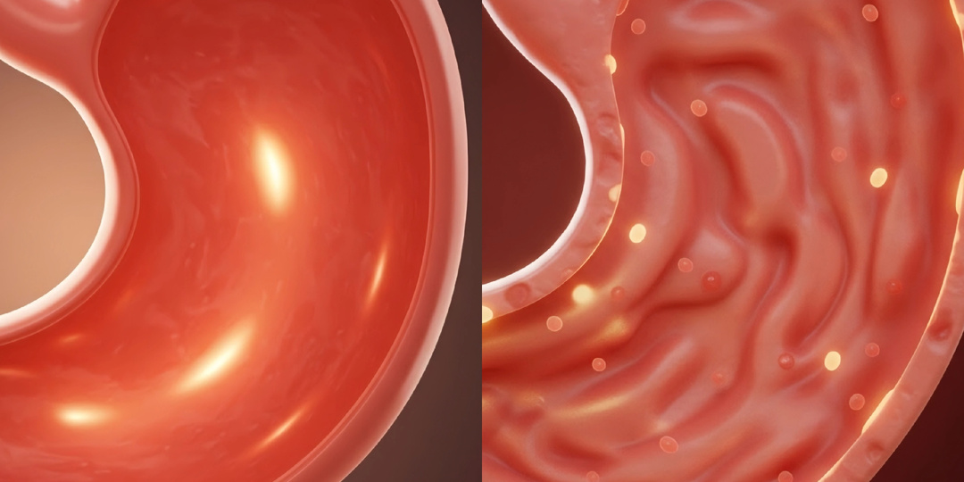 Что такое гастрит на самом деле?