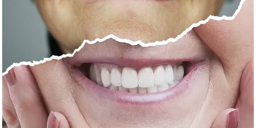 Полностью без зубов? Не паника, а план: какие протезы действительно работают и как выбрать свой