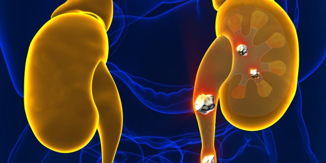 Камни в почках: как они появляются, почему болят и что делать, чтобы не лежать на операционном столе