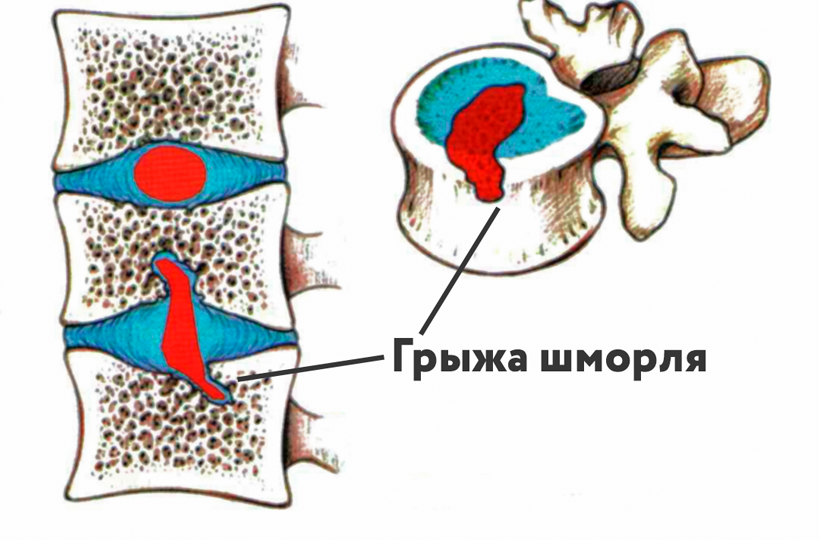 Что такое грыжа Шморля, и опасна ли она?