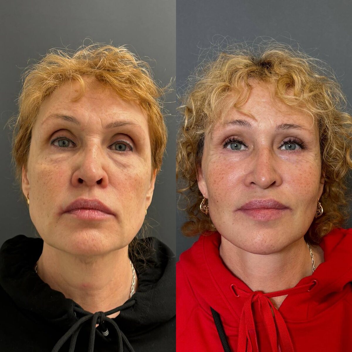 Комплексное омоложение лица: 6 месяцев после операции. Хирург Остринская Т.В.