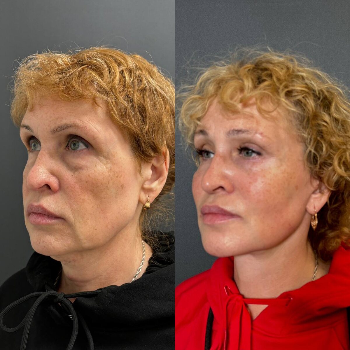 Комплексное омоложение лица: 6 месяцев после операции. Хирург Остринская Т.В.