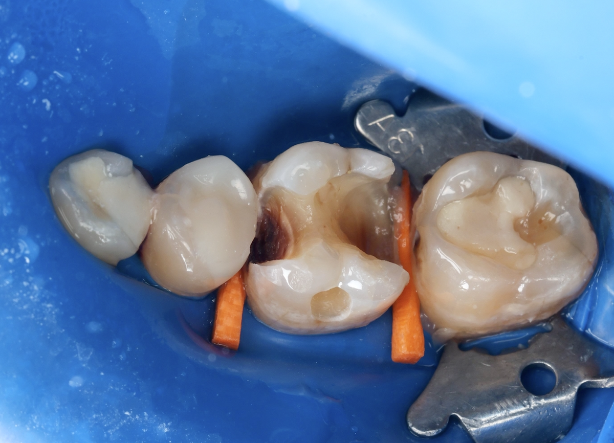 CID дентин нужно убирать - оно и так понятно