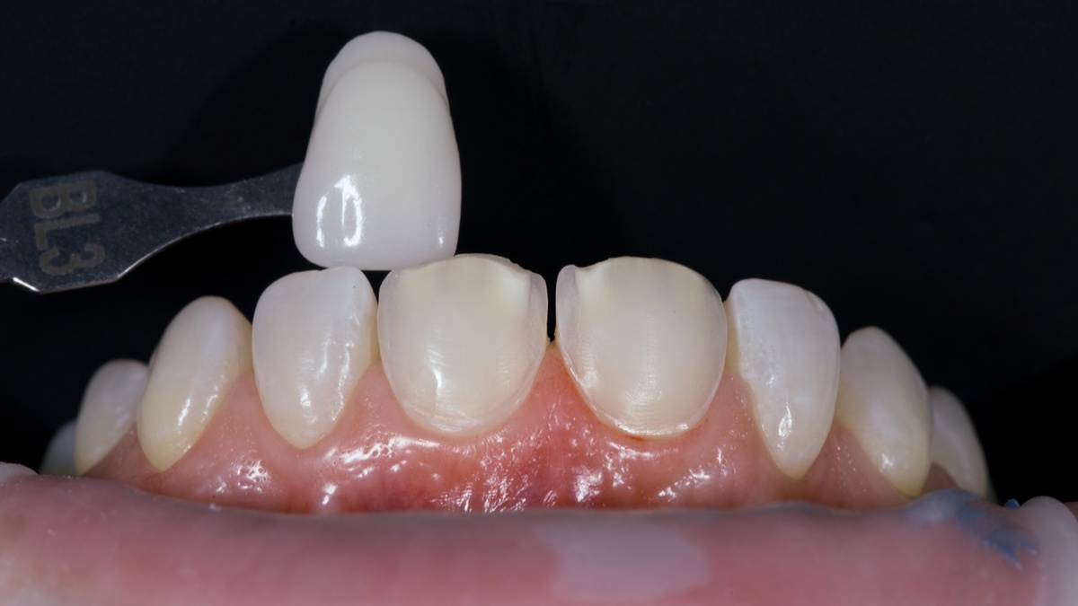 Подбор цвета. Сохранение диастемы по просьбе пациента