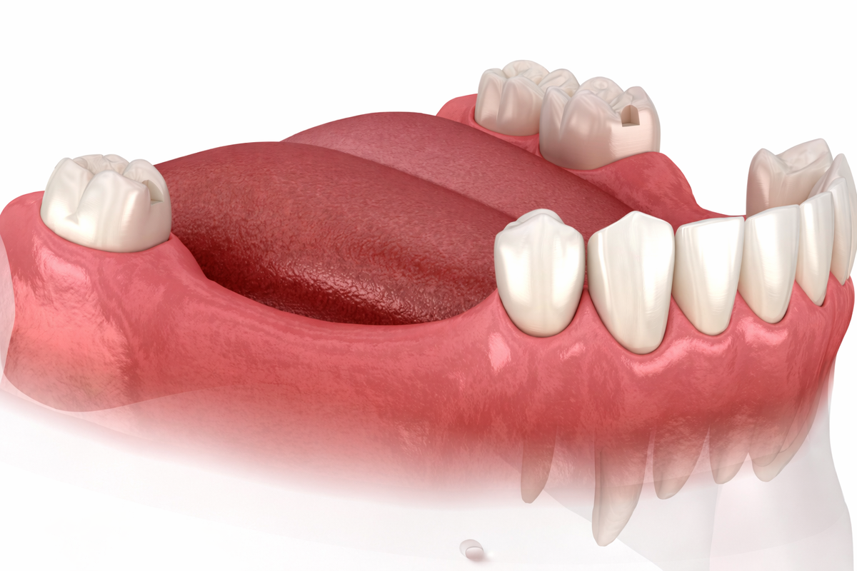 Атрофия костной ткани в месте где долгое время отсутствует зуб