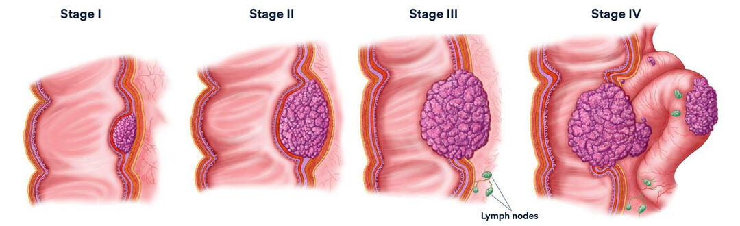 Первые сигналы опухолевых процессов, которые путают с «возрастом»