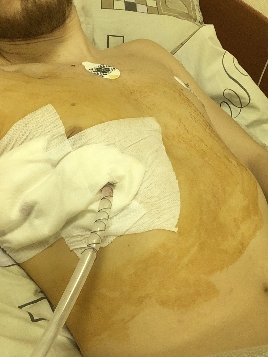 Лежу в больнице после операции с трубкой в груди