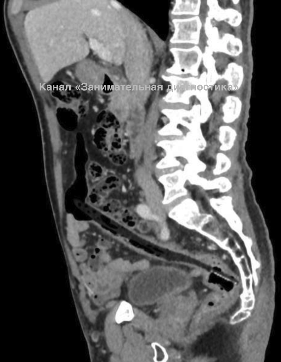 КТ мужчины. Выявлена зубная щетка в просвете прямой и сигмовидной кишки