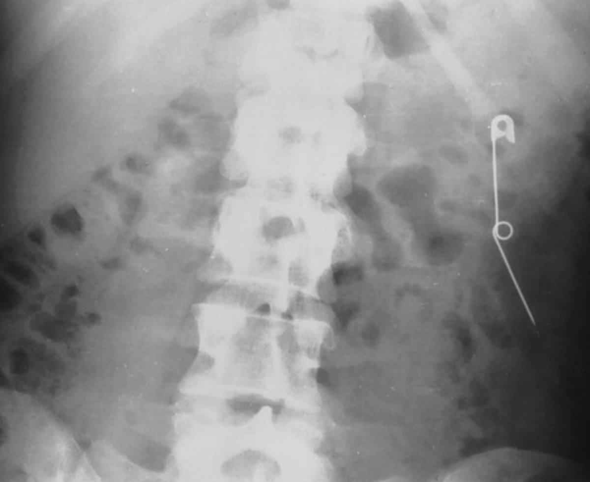 Рентгеновский снимок молодой женщины, которая периодически проглатывала булавки и лезвия бритвы, показывает открытую английскую булавку в нисходящей ободочной кишке.