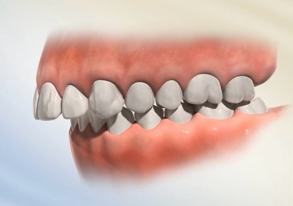 Дистальный прикус, схема